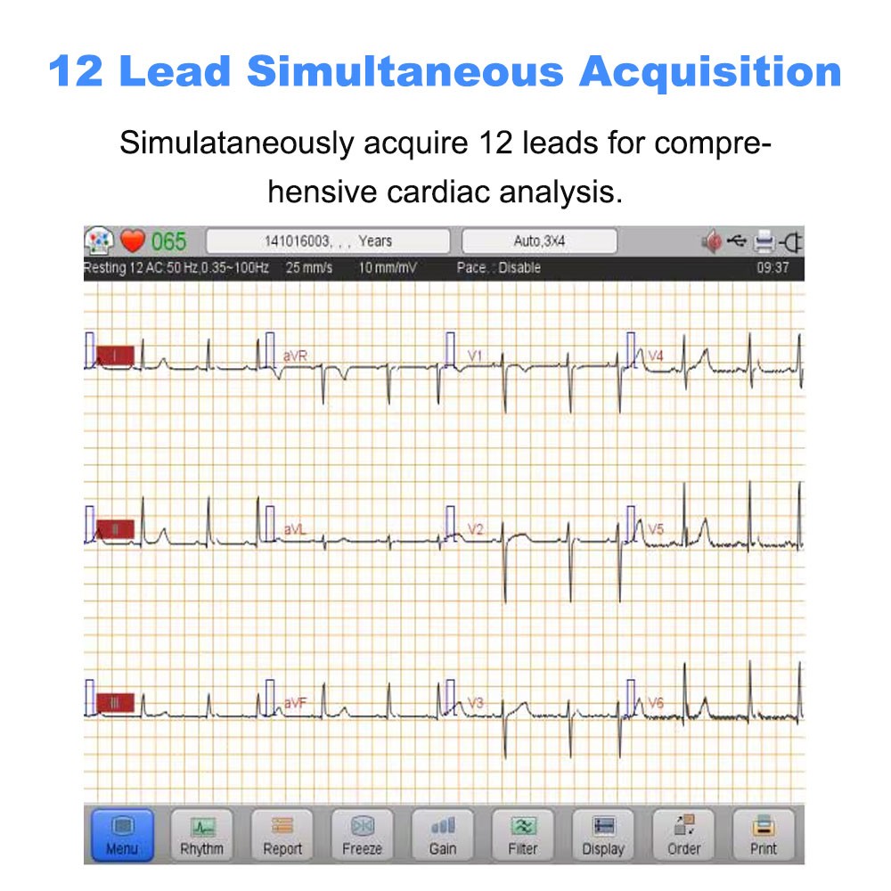 IE6 12-Lead 6-Channel ECG EKG Machine Electrocardiograph with Interpretations US