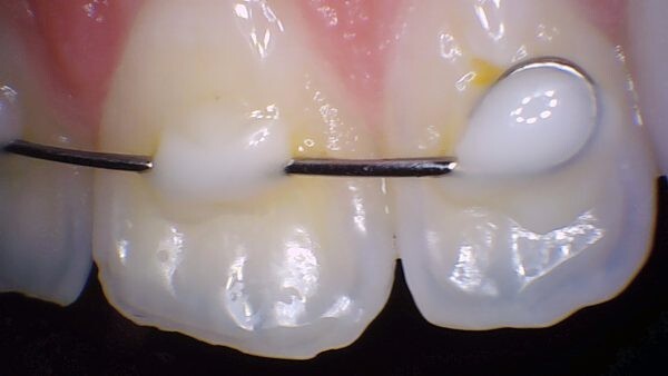 PerfectCam HD Intraoral Camera, USB Dental Camera, Free Capture Button Software.